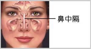 鼻中隔偏曲