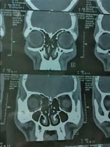 鼻中隔偏曲ct圖