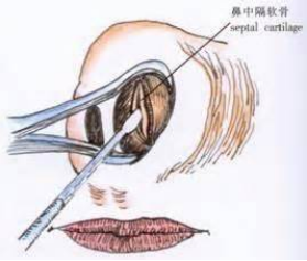 鼻中隔手術(shù)