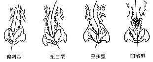 鼻中隔偏曲的分類