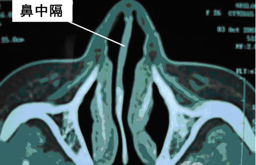 鼻中隔偏曲CT