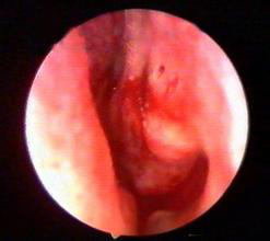 萎縮性鼻炎治療前的內窺鏡檢查