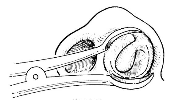 萎縮性鼻炎的手術治療