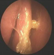 萎縮性鼻炎的內(nèi)窺鏡圖