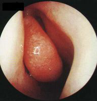 萎縮性鼻炎的內窺鏡檢查圖