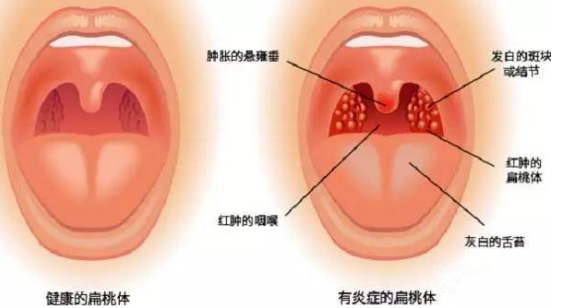 自己檢查扁桃體