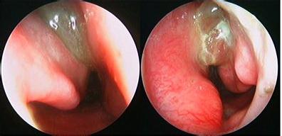 萎縮性鼻炎癥狀