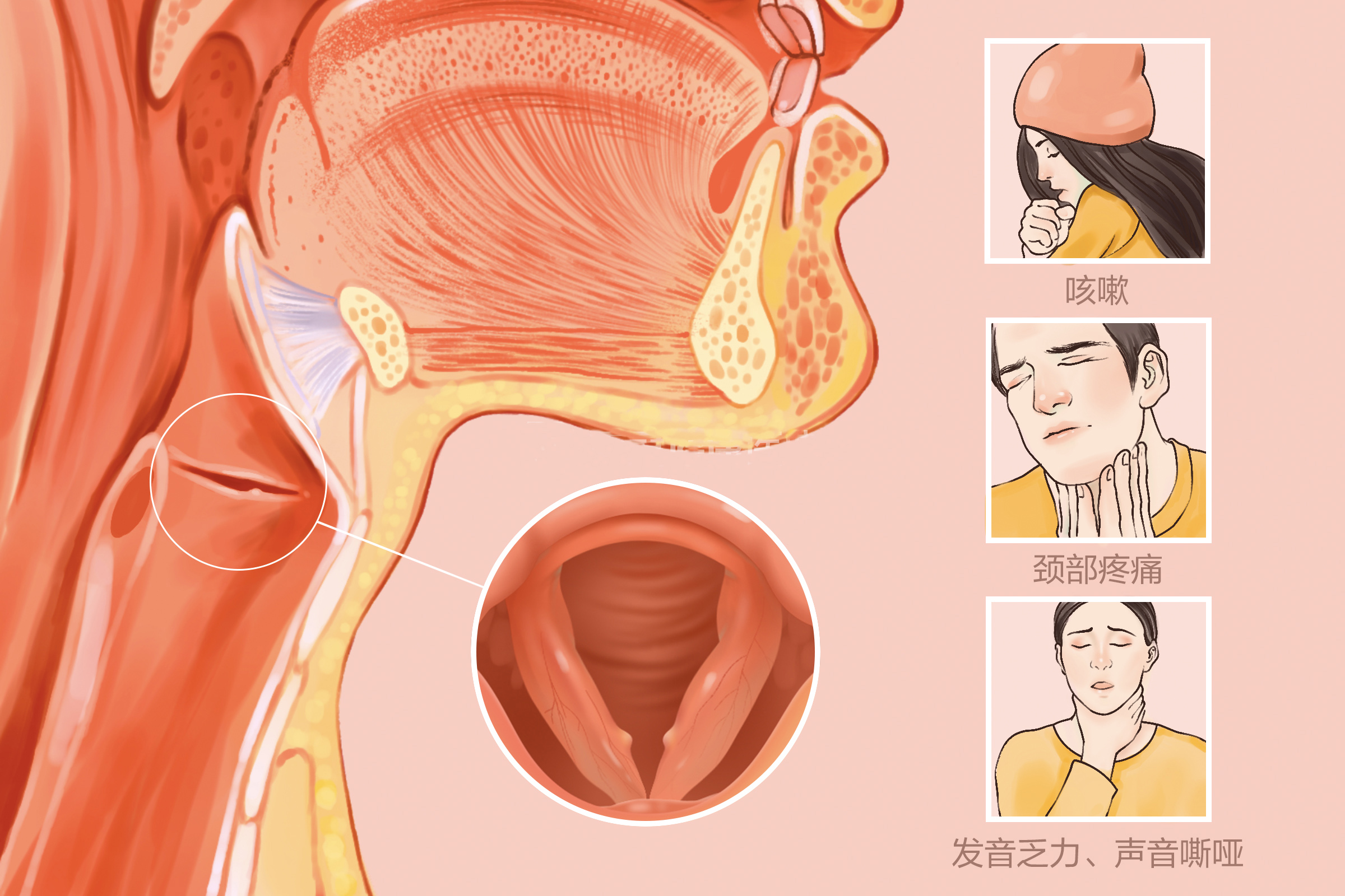 成都治療聲帶小結醫院