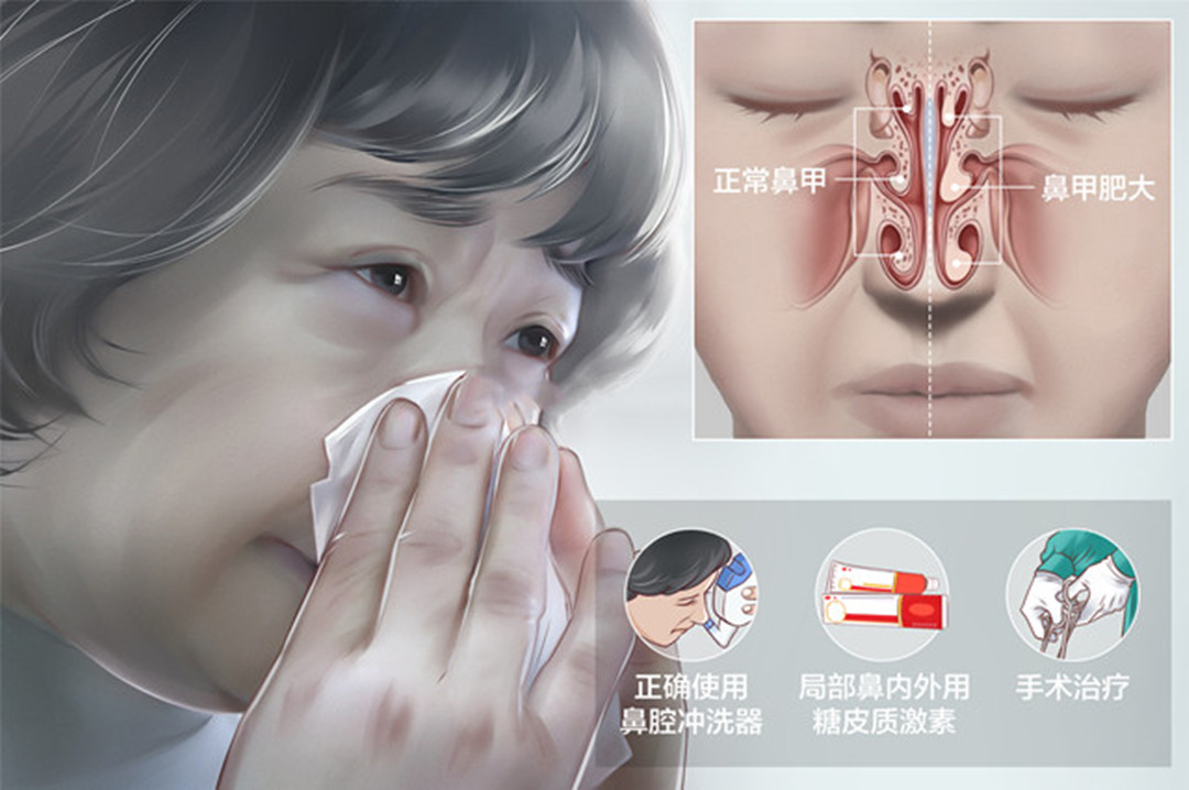 用力擤鼻涕可能會導(dǎo)致鼻甲肥大